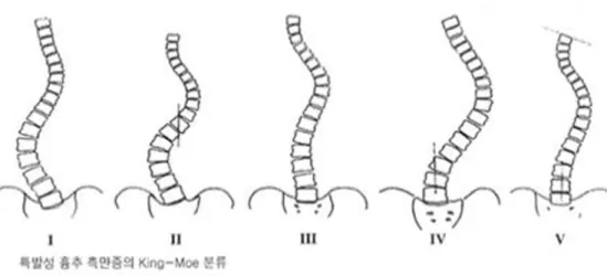 Table Ⅱ. King-Moe’ s Classification on Scoliosis