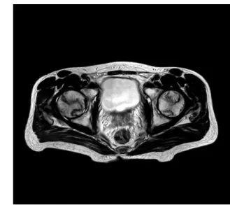 Fig. 1. Leg x-ray(2014.02.03.).  Fig. 2. Leg MRI T2(axial view, 2012.06.25.).