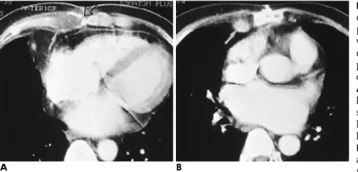 Fig. 1. 40-year-old man with acute peri- peri-chondritis. He had had mitral valve  re-placement(MVR) 40 days before and was suffering from substernal pain and discharge at wound site