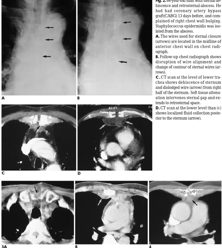 Fig. 2. 64-year-old man with sternal de- de-hiscence and retrosternal abscess. He had  had  coronary  artery  bypass graft(CABG) 13 days before, and  com-plained of right chest wall bulging.