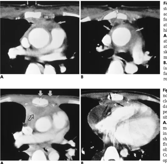 Fig. 6. 22-year-old man with postster- postster-notomy abscess. The patient had had closure of ventricular septal defect 32 days before