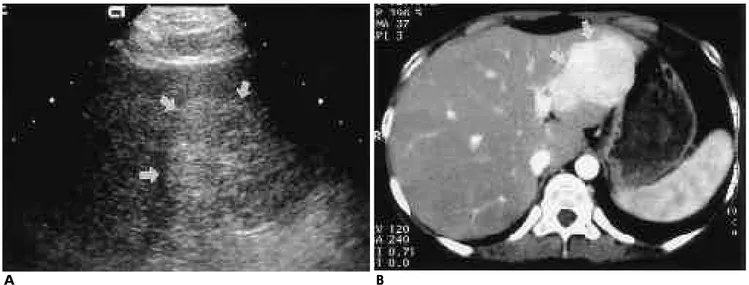 Fig. 6. Pancreas enlargement. Enhanced CT scan shows dif- dif-fuse enlargement of pancreas without adjacent fat infiltration.