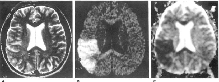 Fig.  1.  Hyperacute stage  (5  hours  after  onset) infarction  in  a 52-year  old  man  with  the  left  hemiparesis  and  aphasia