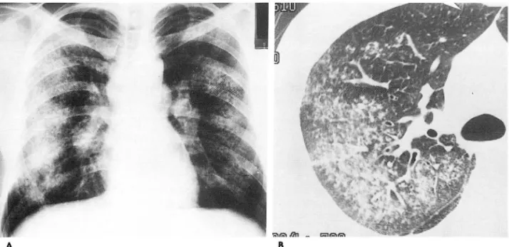 Fig.  8.  31-year-old  man  with  sarcoidosis. 