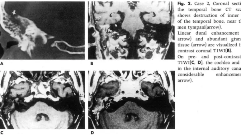 Fig.  2.  Case  2 ,  Coronal  sections  of  the  temporal  bone  CT  scan  (A)  shows  destruction  of  inner  cortex  of the  temporal  bone ,  near  the  teg  men  tympani(arrow)