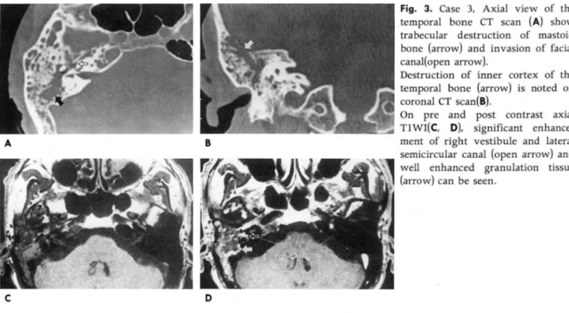 Fig.  3.  Case  3 ,  Axial  view  of  the  temporal  bone  CT  scan  (A)  show  trabecular  destruction  of  mastoid  bone  (arrow)  and  invasion  of  facial  canal(open  arrow)