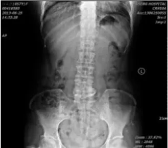 Fig. 1. L-spine x-ray(2013.06.25).