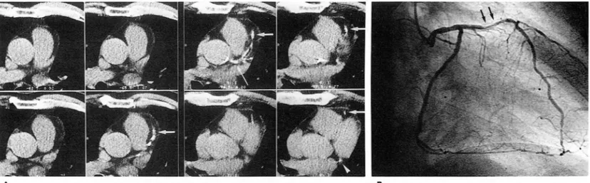 Fig.  2.  Asymptomatic  coronary  artery  obstructive  disease.  66  year-old  male  patient  shows  3  calcified  arteries(a),  left  main(thin  white  arrow),  left  anterior  descending(LAD,  hick  white  arrow },  and  left  circumflex  artery(arrow  h