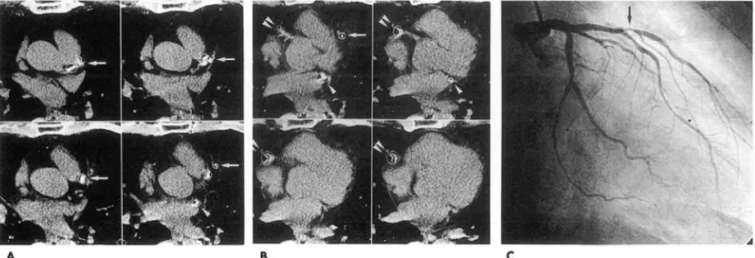 Fig.  4.  Symptomatic  coronary  artery  obstructive  disease.  61  male  patient  shows  3  calcified  arteries(A,  B