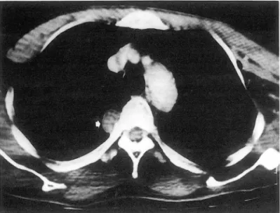 Fig.  2.  36-year-이 d  male  patient  who  had  multiple  fratures  on  upper  extremity  d ue  to  motor  vehicle  acci  dent  one  month  ago