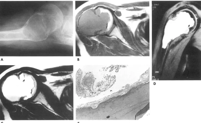 Fig.  1.  A.  Right  shoulder  axillary  view  shows  a  well  defined  osteolytic  lesion  with  bulging  contour  and  thin  sclerotic  rim  on  the  metaphysis  and  epiphysis  of the  humerus
