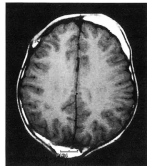 Fig.  4.  TlνV  axial  brain  MRI  shows  multiple skull  bossings  with  widening and  fat  deposition of the  diploic  space  and  bulging ofthe outer table 