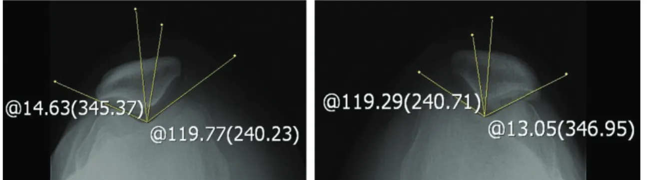 Fig. 2.  Both knee X-ray(Sky-line view) of Case 1(before).
