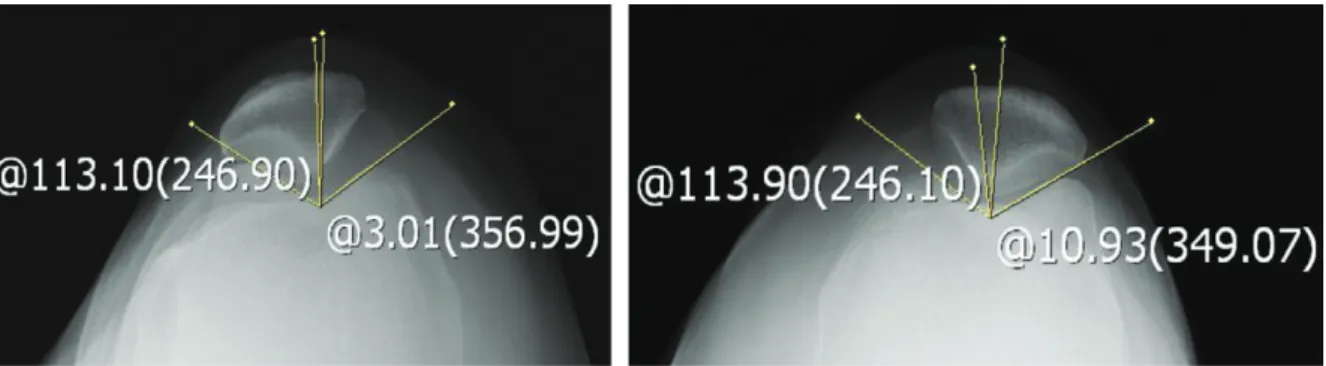 Fig. 7.  Both knee X-ray(Sky-line view) of Case 2(after).