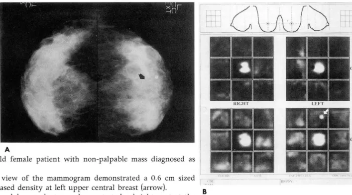 Fig.  1.  52-year-old  female  patient  with  non-palpable  mass  diagnosed  as  fi  br oadenoma