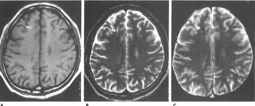 Fig.  1.  A  33-year-old  man  with  diffuse  axonal  injury  (10  days  after  trauma) 