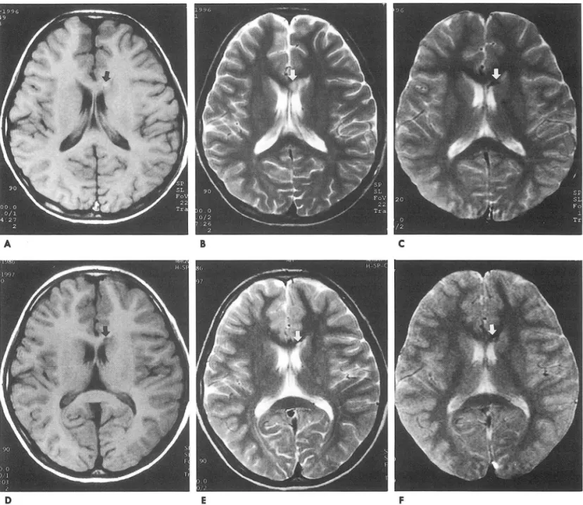 Fig.  3.  A  lO-year-이d  man  with  diffuse  axona1  injury.  On  initia1  MR  images{A -C)  obtained  10  days  after  trauma,  a  small  high  signa1  intensity  1esion  (arrow)  is  seen  in  the  genu of the  corpus  callosum  on  Tl -weighted  image{A