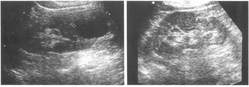 Fig.  2.  A.  Fifty  one  year-이 d  woman  with  simple  renal  cyst  about  45  ml  in  volume  at  lower  pole  of left  kidney
