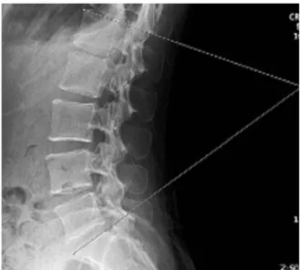 Fig. 1.   Measurement of lumbar lordotic angle.