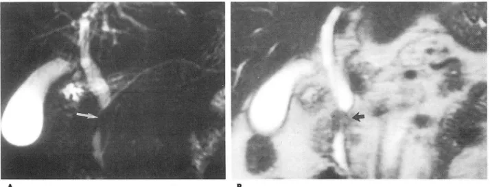 Fig.  1.  65-year-old  man with  resectable  carcinoma  of distal common  bile  duct. 