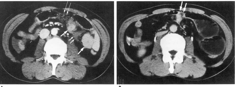 Fig . 3.  Delayed  small  bowel  obstruction  d ue  to  perforation  of proximal  jej un um  in  a  38- year-old  man