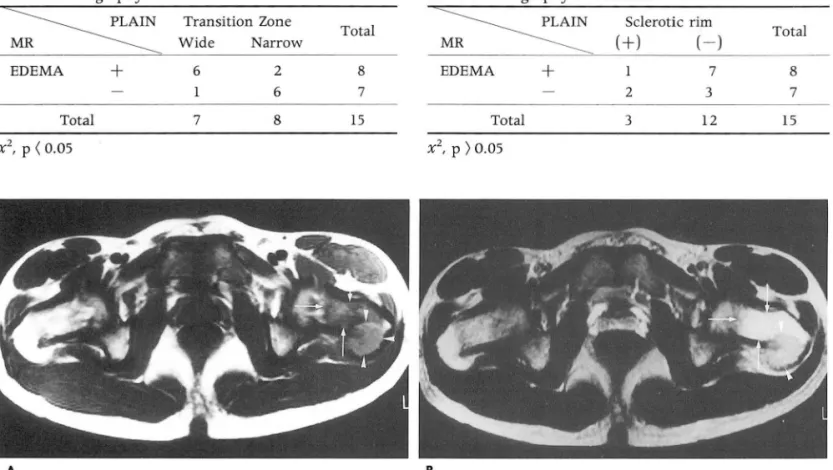 Table  2.  Correlation  of BM  Edema  on  MR  and  Transition  Zone  on  Radiography of the  GCT 