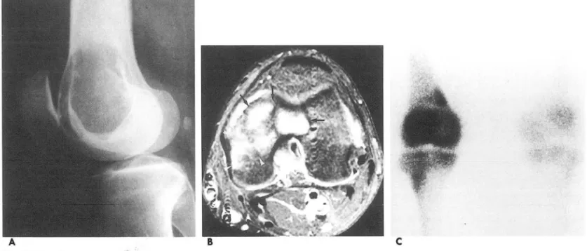 Table  4.  Correlation  of  BM  Edema  on  MR  and  Aggress- Tab le  S.  Correlation  of  Hypointense  Rim  on  MR  T1 WI  lveness  on  Radiography  of the  GCT  and  Marginal  Sclerosis  on  Radiography  of the  GCT 
