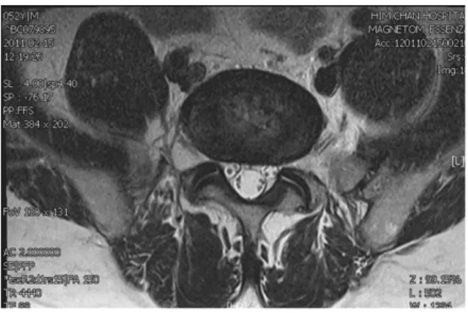 Fig. 3. L5~S1 Axial image of L-spine.  Fig. 4. Sagittal Image of L-spine.