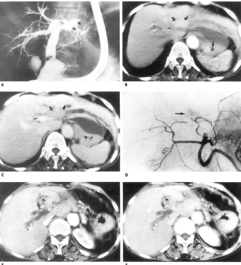 Fig.  1.  A.  ERCP  reveals  a  lobulated  filling  defect (arrows)  within the  biliary  tree  of the  left  lateral  segment