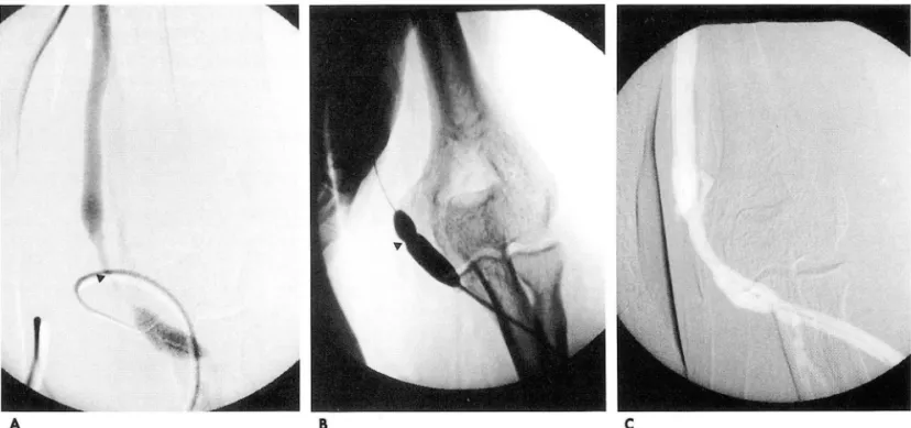 Fig.  1.  A.  Venogram  obtained  at  the  level  of elbow joint  shows  a  stenosis  in  basilic  vein(arrowhead)