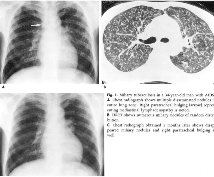 Fig.  1.  Miliary  tuberculosis in  a  34-year-이d  man  with  AIDS. 