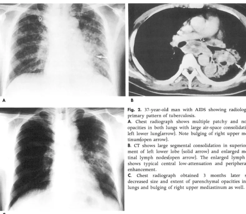 Fig.  2.  37-year-old  man  with  AIDS  showing  radiologically  primary  pattern  of tuberculosis