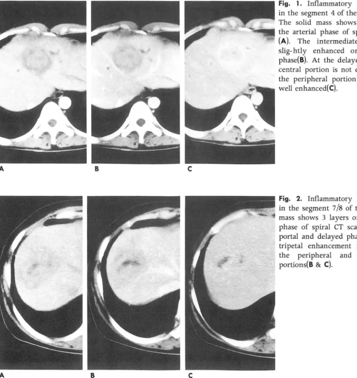 Fig.  1.  In f1 ammatory  pseudotumor  in the  segment  4  of the  liver. 