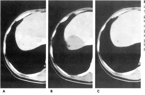 Fig.  3.  Inflammatory  pseudotumor  in  the segment  7  of the  liver  The  mass  shows  relatively   homo-geneous  low  attenuation  with   cen-tral  low  attenuation  foci