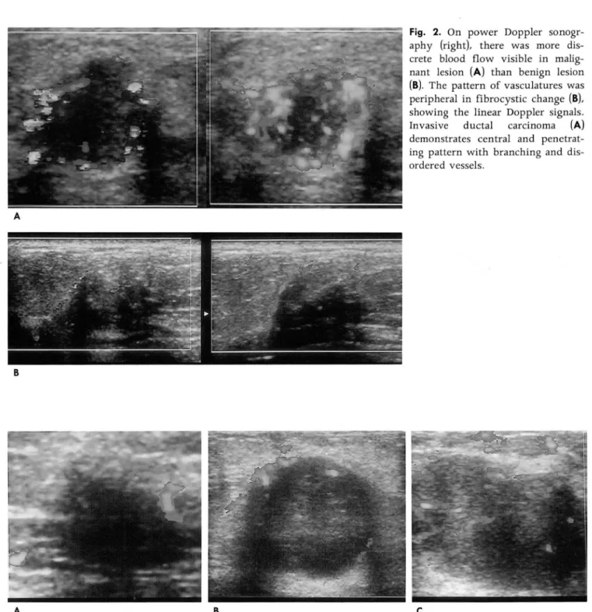 Fig.  3.  False  negative  and  false  positive  cases  on  power  Doppler  sonography