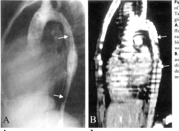 Fig.  1.  Aortic  dissection  after  PT  A  of  descending  thoracic  aorta  in  Takayasu  arteritis  of  lO -year-old  gir l