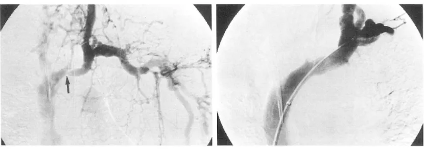 Fig.  1.  A.  Upper  extremity  venogram  showed  focal  stenosis  (arrow)  of Jeft  innominate  vein  with  extensive collateraJ  cir- cir-culation 