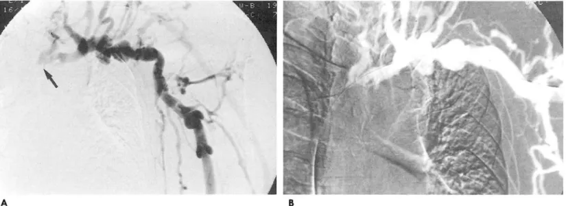 Fig.  2.  A.  Predilation  venogram  showed  a  obstruction  of  left  innominate  vein