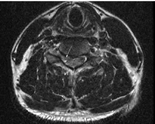 Fig. 2.  C-spine MRI (sagittal view, 2012.04.14).