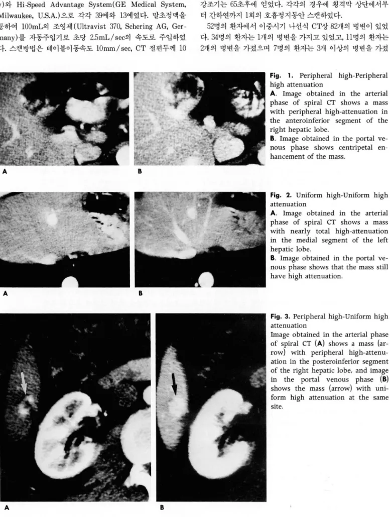 Fig.  1.  Peripheral  high-Peripheral  high  attenuation 