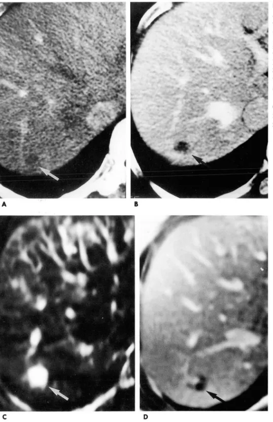Fig.  4.  Low-Low attenuation  A,  B.  CT  scan  obtained  in  the   ar-terial  phase  {A}  shows  a   low-atten-uated  nodule  {arrow}  located  in  the  posterosuperior  segment  of the  right  hepatic  lobe,  and  CT  scan  in  the  portal  venous  phas
