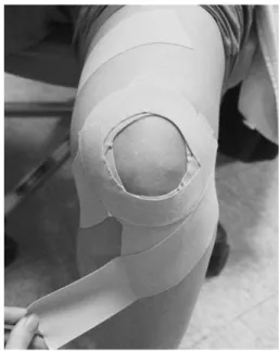 Fig. 4. Method of taping therapy in thigh and leg.