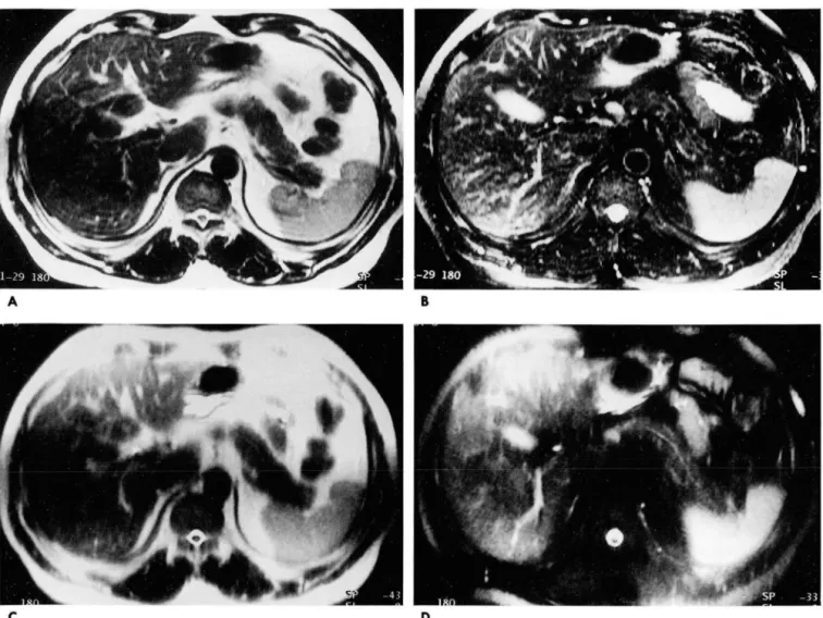 Fig.  1.  MR  images  of  normal  pancreas  using  TSE  (TR/effective  TE/echo  train  length=3500msec/138msec/29,  matri x  size = 116 X 256 ,  FOV=263mm X 350mm)  (A),  FS-TSE  (8),  HASTE  (effective  TE /echo  train  length=87msec/!28msec,  matrix  siz