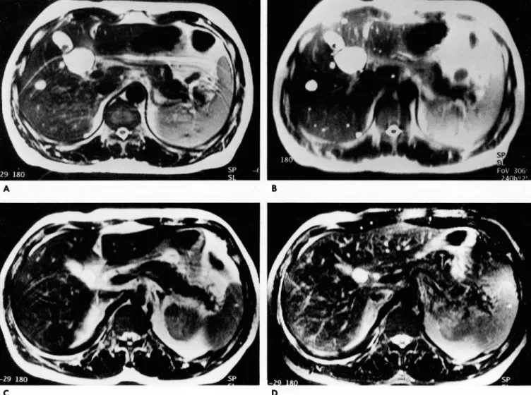 Fig.  2.  The  ghost  artifact  in  TSE  image(A)  appears  as  lines  parallel  to  subcutaneous  fat  in  anterior  abdominal  wal l