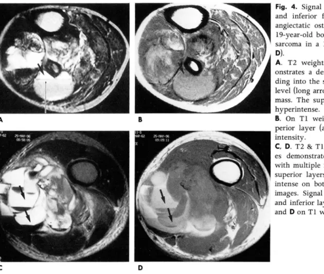 Fig.  4.  Signal  intensity  of  superior  and  inferior  fluid  layers  in  a   tel-angiectatic  osteogenic  sarcoma  in  a 