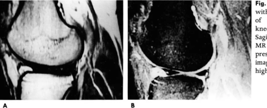 Fig.  3.  Thirty  four-year-old  man  with  meniscal  tear  of posterior  horn  of  the  medial  meniscus  of  right  knee 