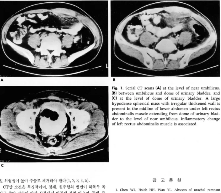 Fig.  1.  Serial  CT  scans  (A)  at  the  level  of near  umbilicus ,  (8)  between  umbilicus  and  dome  of  urinary  bladder ,  and  (C)  at  the  level  of  dome  of  urinary  bladde r