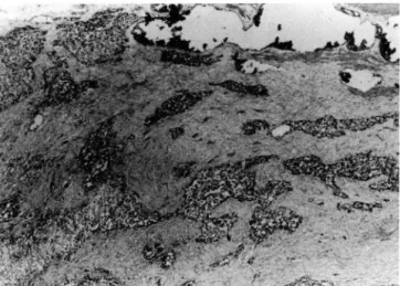 Fig.  3.  Microscopic  appearance of the  resected  mesenteric  tumo r.  The  tumor  exhibits  small  nests  or  solid  sheets  without  organoid  pattern  separated  by  myxoid   desmo-plastic  stroma  (H  &amp;  E ,  X  4이 