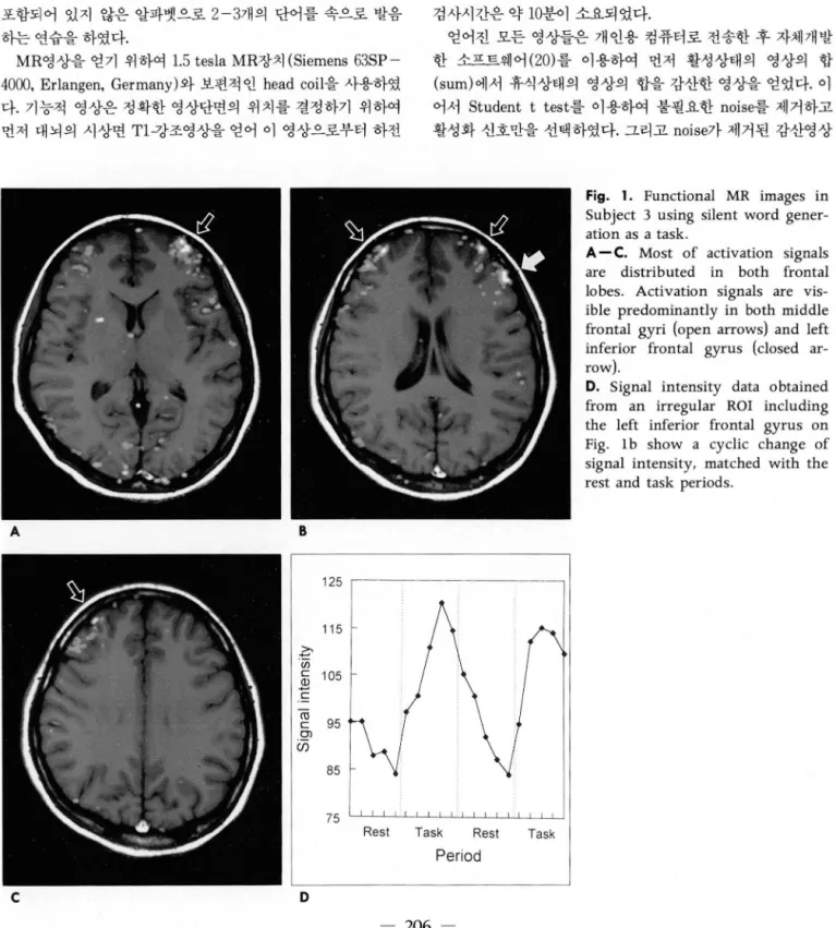 Fig.  1.  Functional  MR  images  in  Subject  3  using  silent  word   gener-ation as  a task