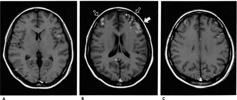 Fig.  3.  Repeated  functional  MR  images  in  Subject  3  using  silent  word  generation 